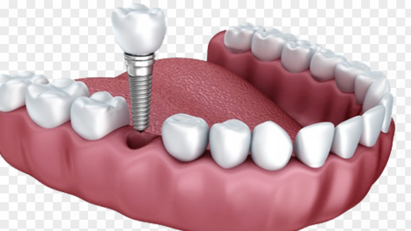 Dental Anatomy Of Teeth Implant Dentistry Dentures PNG