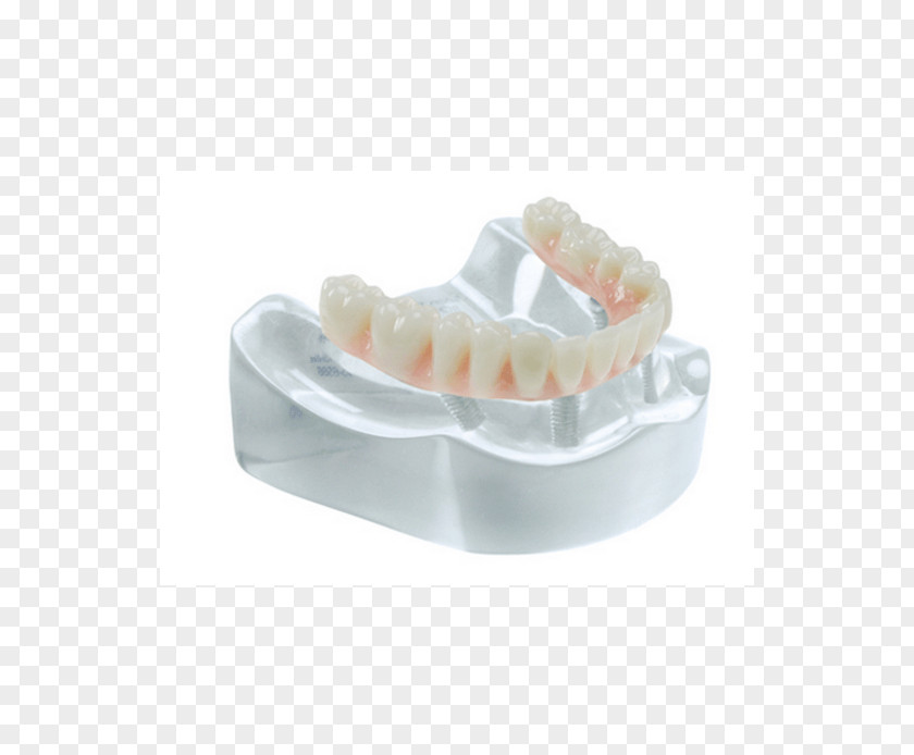 Bridge Tooth Dental Implant Specialty Salvin Specialties PNG