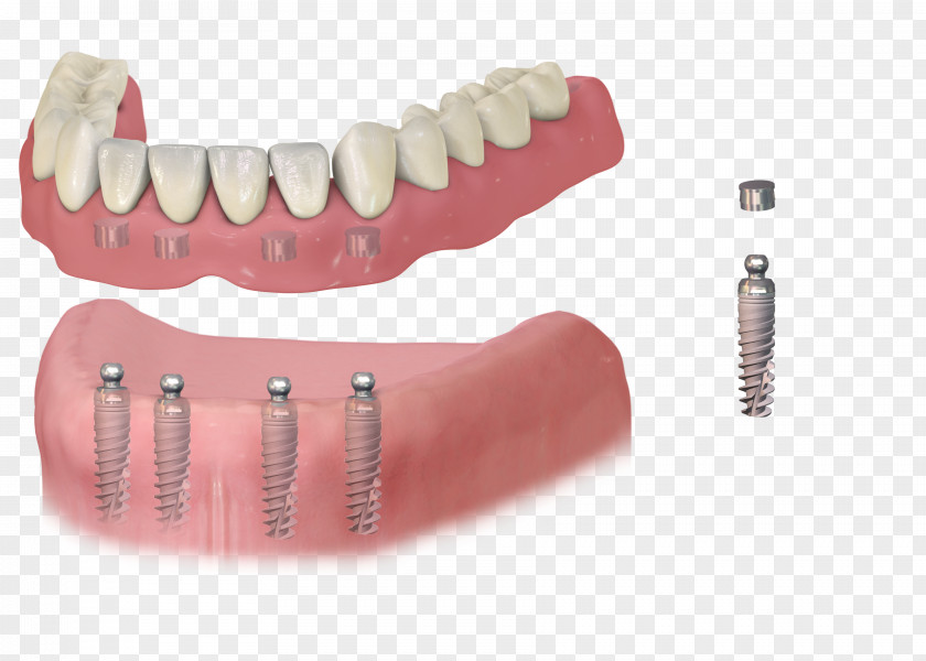 Bridge Dental Implant Dentistry Dentures Removable Partial Denture PNG