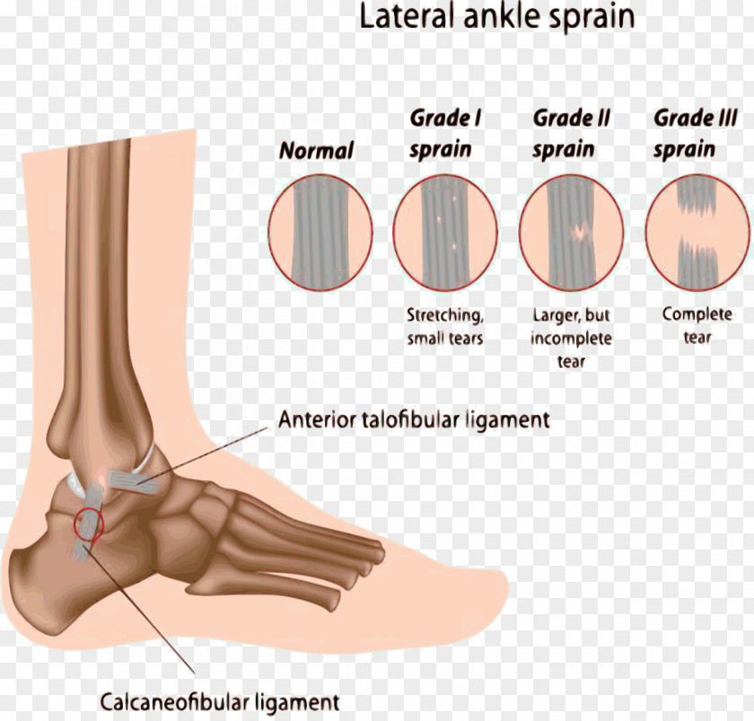 Chiropody Treatment Sprained Ankle High Sprain Injury PNG