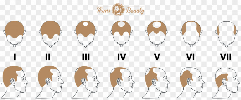 Hair Pattern Loss Transplantation Hamilton–Norwood Scale PNG