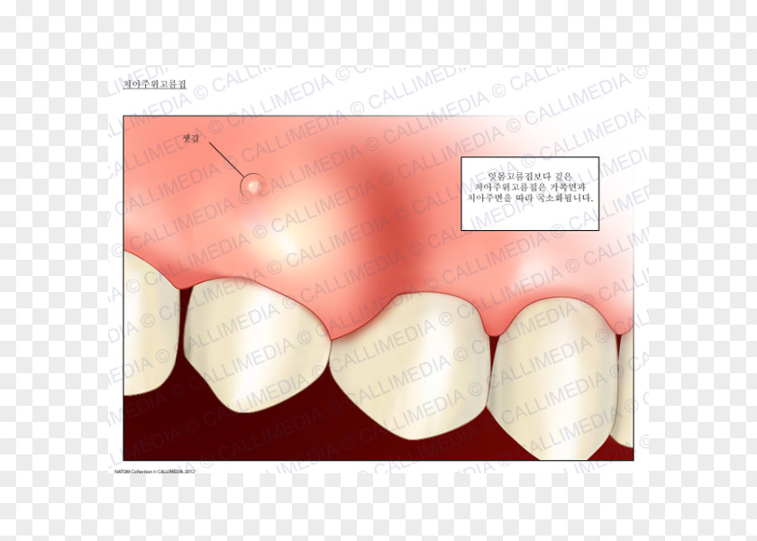 Human Respiratory System Dental Abscess Periodontal Gums Tooth PNG