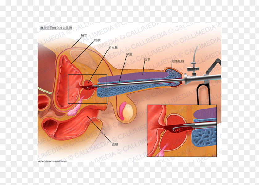 Prostate Gland Transurethral Resection Of The Benign Prostatic Hyperplasia Cancer Surgery PNG