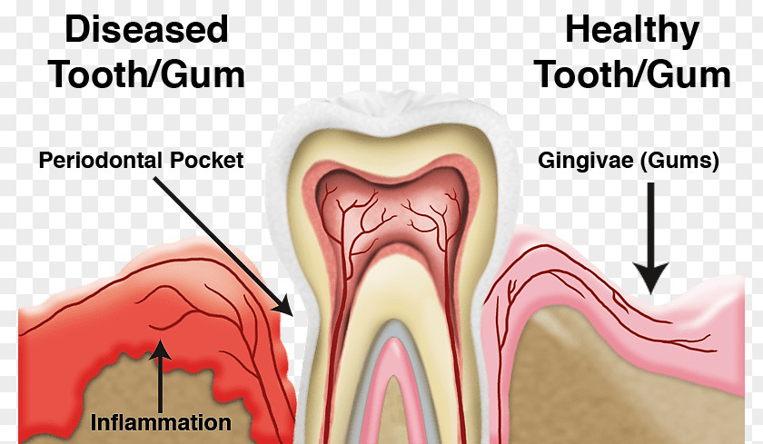 Periodontal Disease Gums Periodontology Dentistry PNG