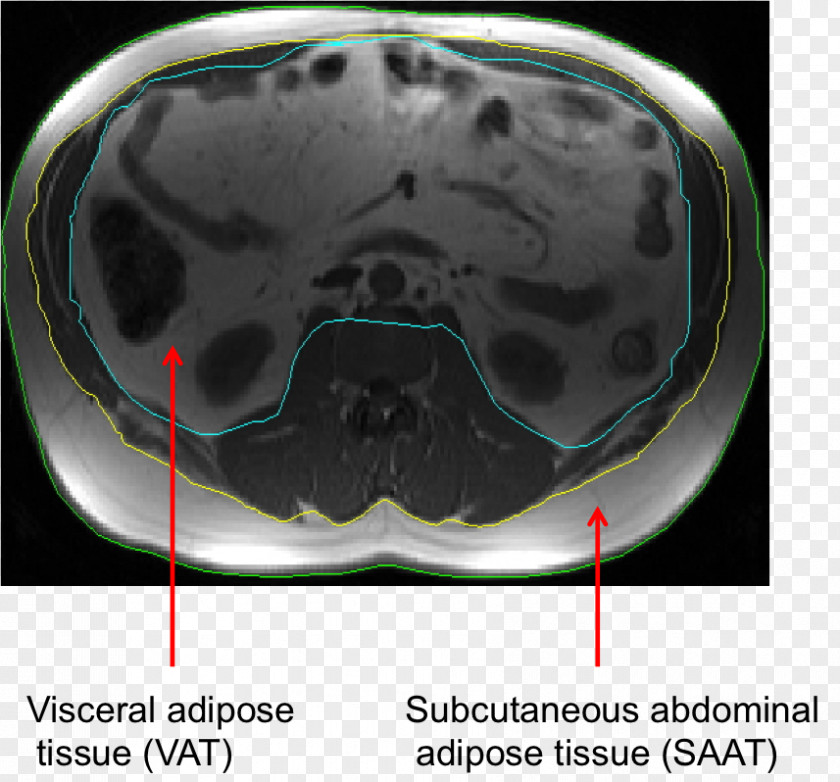 Liver Cancer Non-alcoholic Fatty Disease Gastroenterology PNG