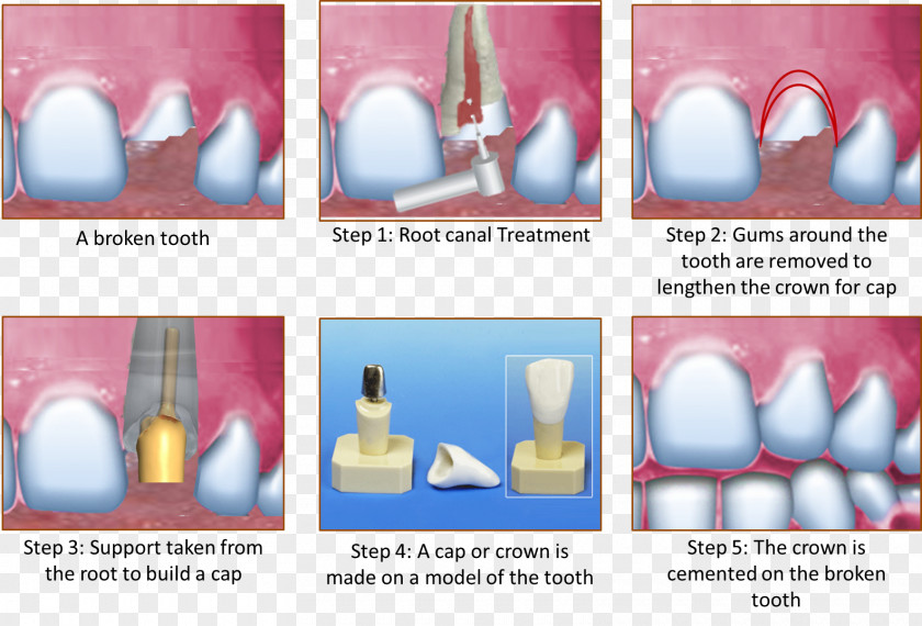 Crown Root Canal Cracked Tooth Syndrome Human PNG