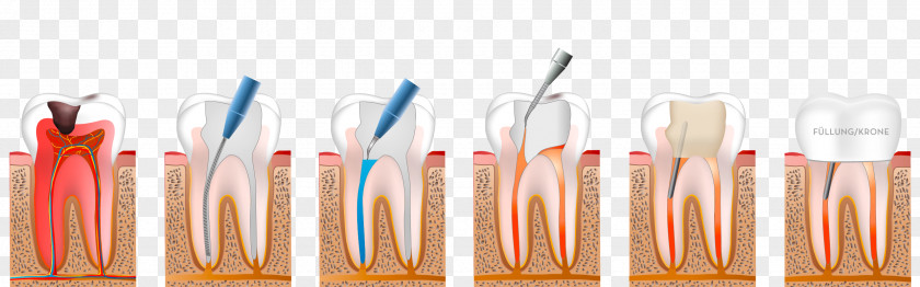 Orange Dentistry Endodontic Therapy Endodontics PNG