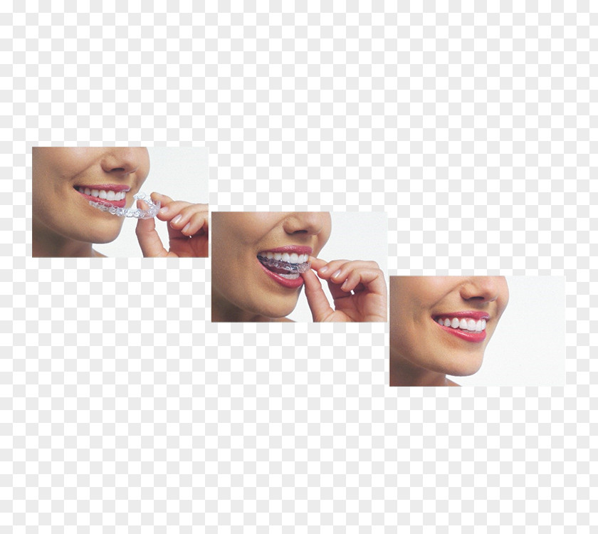 Teath Clear Aligners Dental Braces Orthodontics Dentistry PNG