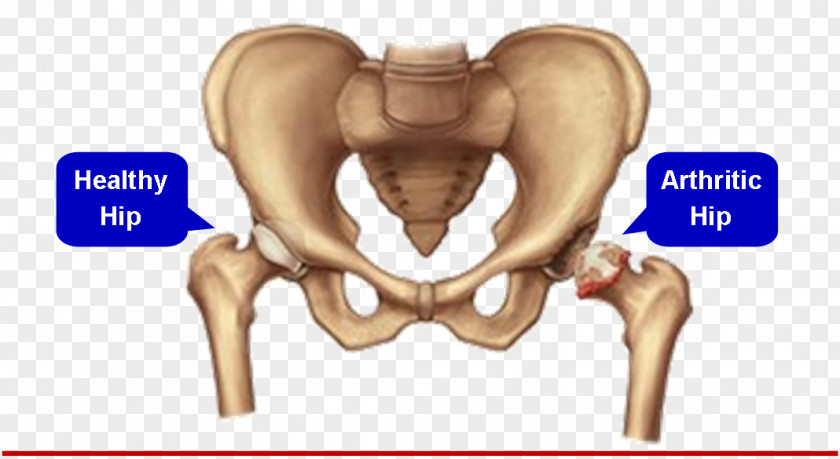 Meniscus Hip Replacement Joint Surgery Knee PNG