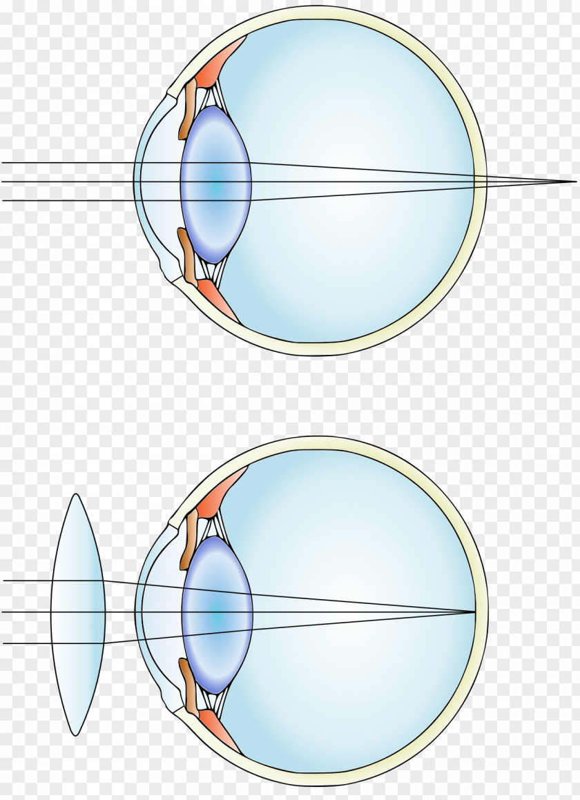 .vision Near-sightedness Hypermetropia Corrective Lens Astigmatism Refractive Surgery PNG