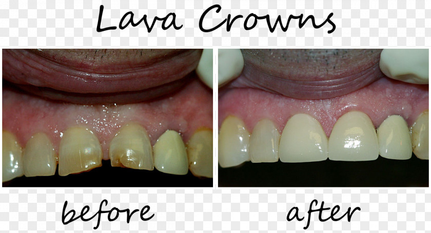 Crown Tooth Cosmetic Dentistry PNG