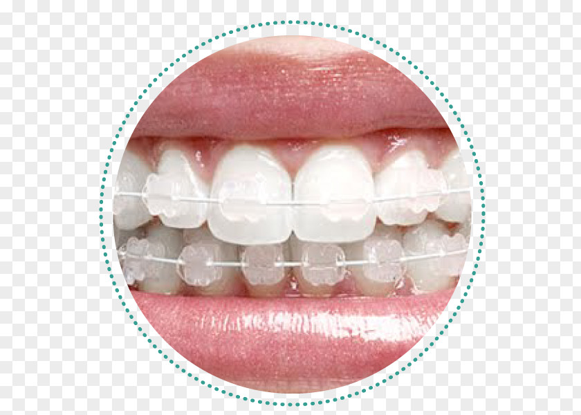 Bracket Dental Braces Orthodontics Dentistry Tratamento PNG