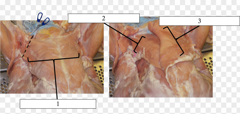 Warming Up The Spleen And Kidney Common Iliac Artery Femoral Vein Inferior Vena Cava Carotid PNG