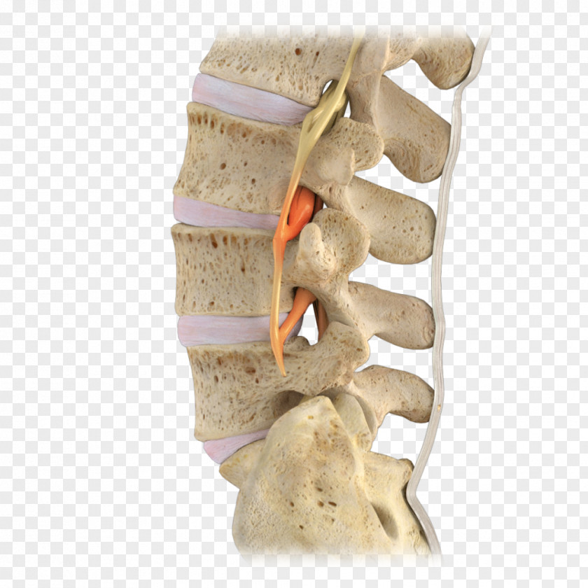 Lumbar Vertebrae Vertebral Column Spinal Stenosis Nerve PNG
