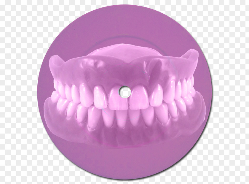 Bridge Dentures Dentistry Dental Implant PNG