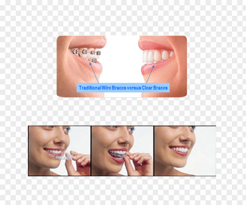 Crown Clear Aligners Cosmetic Dentistry Dental Braces PNG