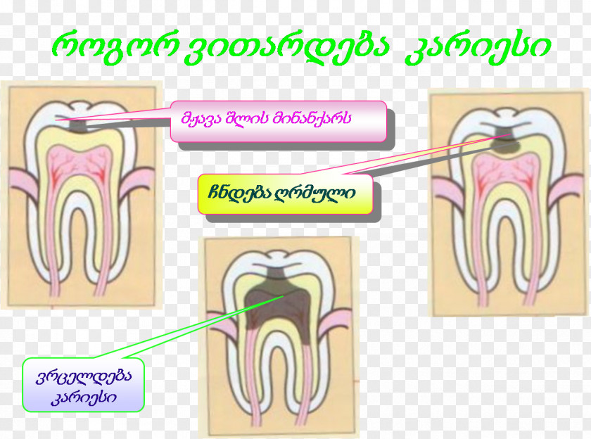 Yn Tooth 0 AD 2 PNG