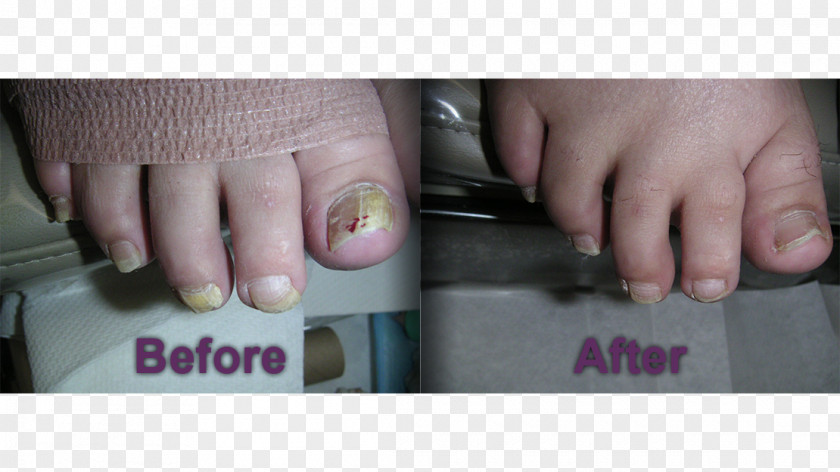 Nail Podiatry Foot Onychomycosis Medicine PNG