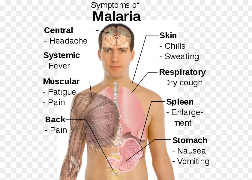 Malaria Symptomatic Treatment Chills Plasmodium Falciparum PNG