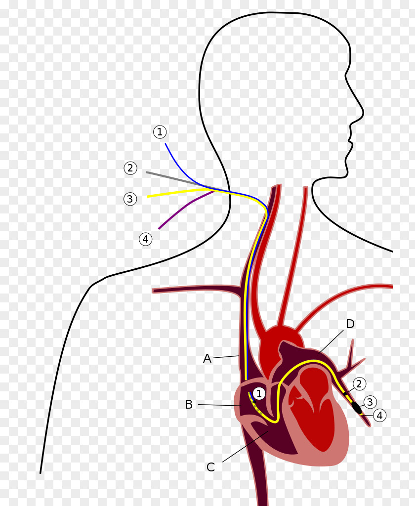 Heart Pulmonary Artery Catheter Hypertension Wedge Pressure PNG