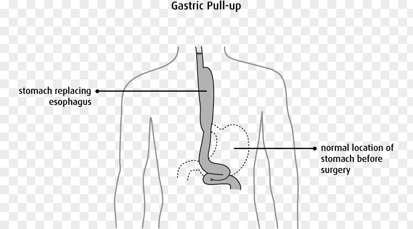 Gastroesophageal Reflux Disease Thumb Surgery /m/02csf Esophageal Cancer Esophagus PNG