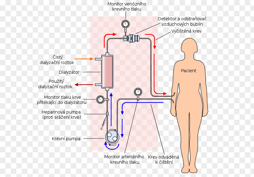 Blood Hemodialysis Chronic Kidney Disease Peritoneal Dialysis PNG