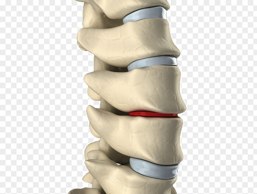 Disease Prevention Lumbar Disc Herniation Intervertebral Spinal Decompression Back Pain Vertebral Column PNG