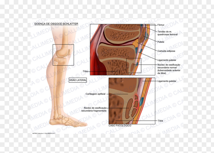 Quadriceps Femoris Muscle Osgood–Schlatter Disease Tuberosity Of The Tibia Growing Pains Therapy PNG