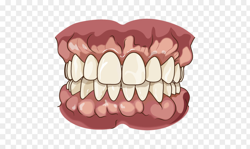 Alveoli Tooth Jaw Dentures Chewing Bruxism PNG