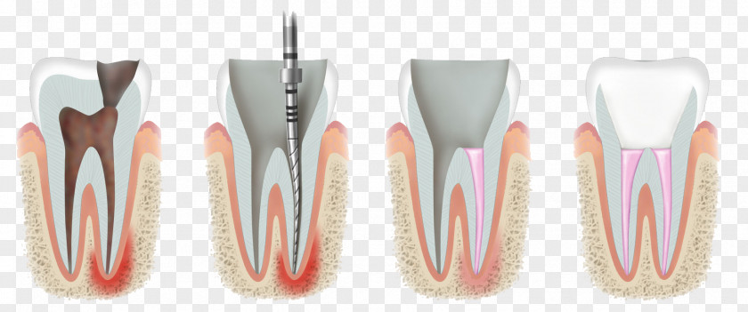 Endodontic Therapy Endodontics Dentistry PNG
