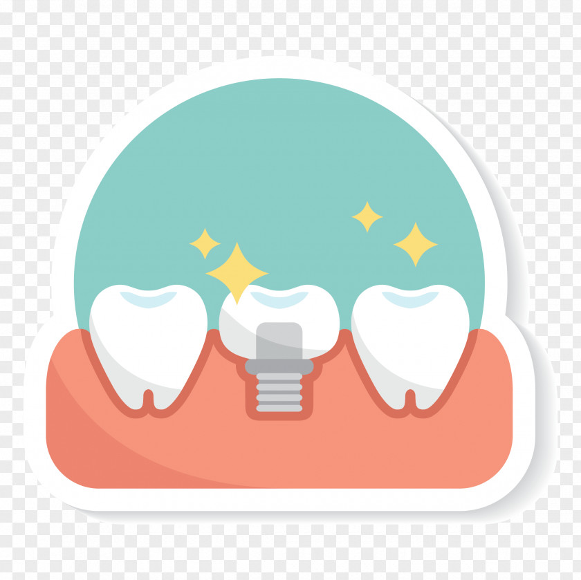 Dental Implant Edentulism Extraction Dentistry Clip Art PNG