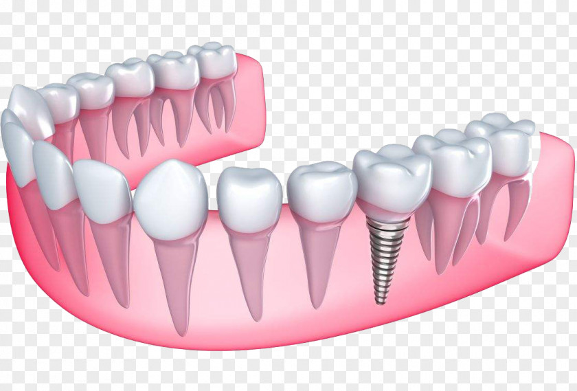 Dental Implant Desert View Dentistry Dentures PNG