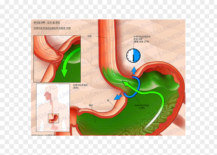 Reflux Esophagus Sphincter Cardia Sfintere Esofageo Inferiore Gastroesophageal Disease PNG