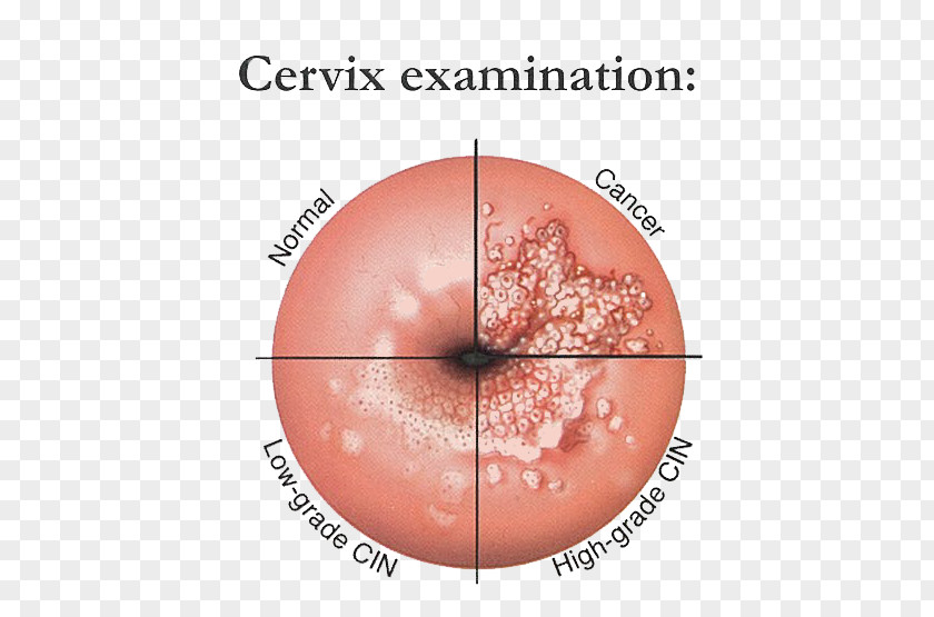 Cervical Cancer Genital Human Papillomavirus Infection Papilloma Virus Vaccine Cervix Intraepithelial Neoplasia PNG cancer human papillomavirus infection intraepithelial neoplasia, 免疫接种能防止包括宫颈癌、白喉、乙肝、麻疹 clipart PNG