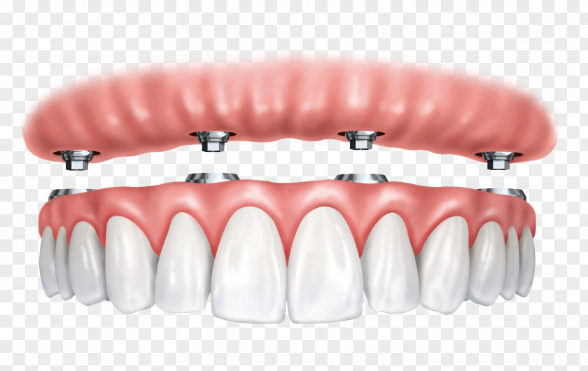 Implants Dental Implant All-on-4 Dentistry Dentures PNG
