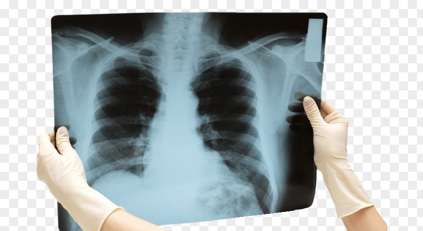 Health Rib Surgery Lung Physician PNG
