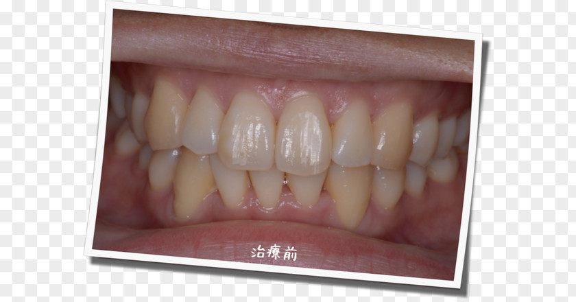 Dental Postcard Tooth Whitening 審美歯科 Dentist Gums PNG