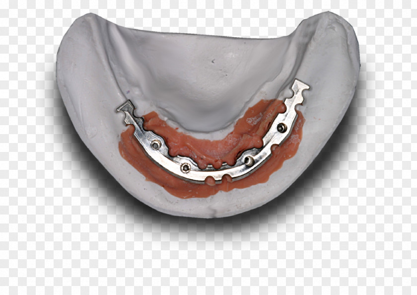Jaw Dental Implant Laboratory Dentistry Dentures PNG