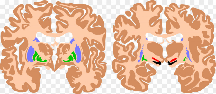 Brain Basal Ganglia Athetoid Cerebral Palsy Cortex PNG