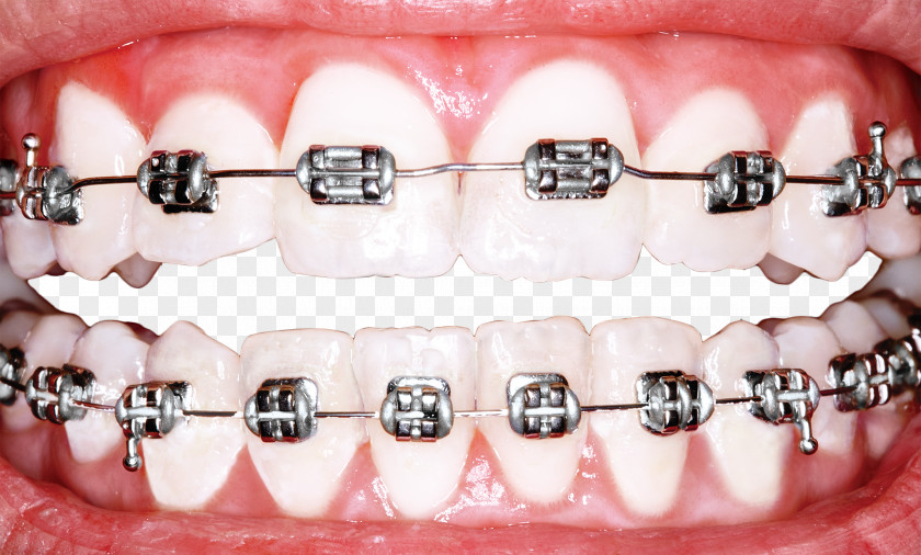 Perfect Teeth Cliparts Dental Braces Dentistry Orthodontics Tooth Whitening PNG