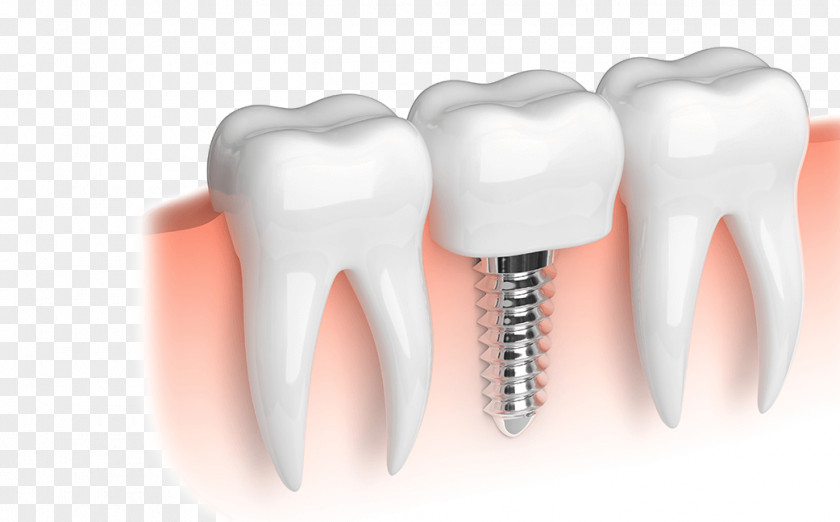 Health Dental Implant Dentistry Restoration Dentures PNG
