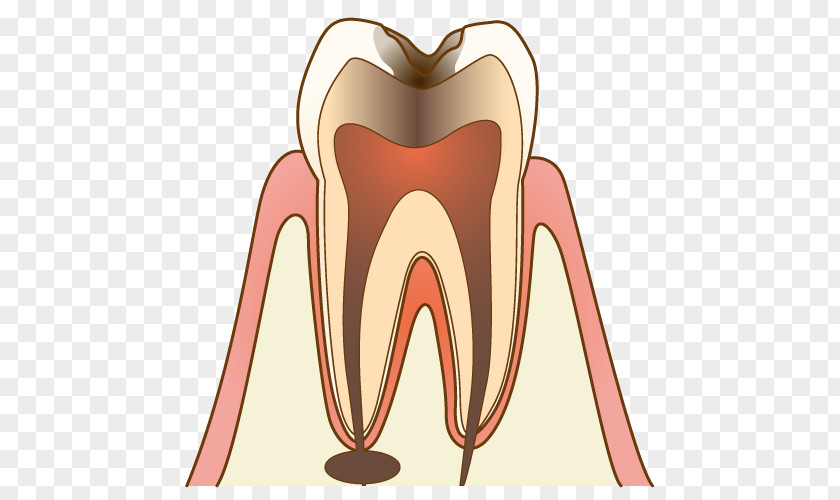 Decayed Tooth 歯科 Dentist Decay Therapy 医院 PNG