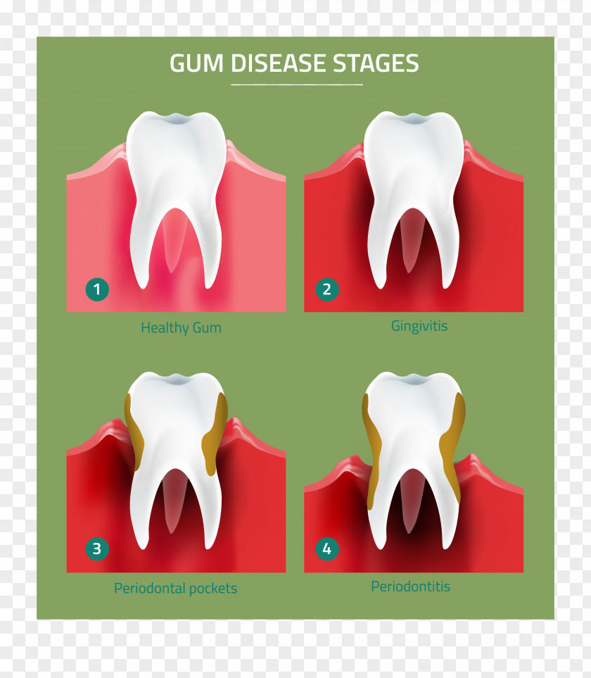 Health Tooth Gums Periodontal Disease Gingivitis Periodontology PNG