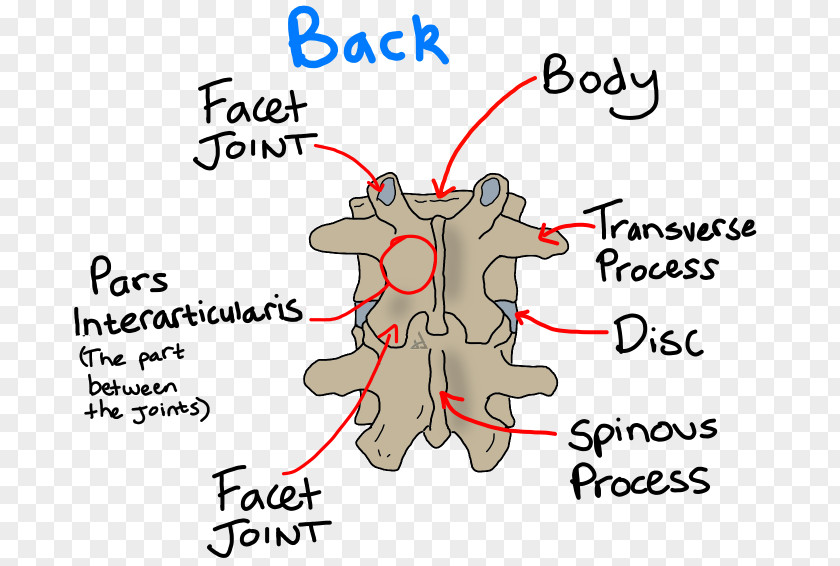 Spine Pars Interarticularis Spondylolysis Spondylolisthesis Vertebral Column PNG