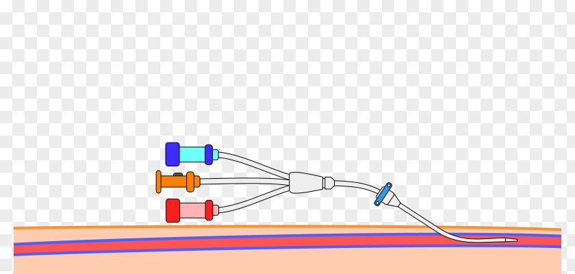 Peripheral Venous Catheter Central Seldinger Technique Arterial Line PNG