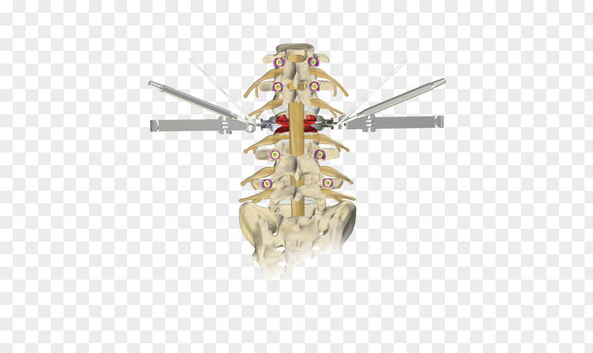 Subtraction Osteotomy Vertebral Column Surgery Kyphosis Lumbar Vertebrae PNG