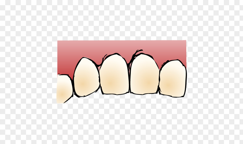Implant Tooth いがらし歯科クリニック Dentist Dental PNG