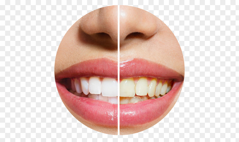 White Teeth Lee And Van Mieghem DDS Cosmetic Dentistry Tooth Whitening PNG