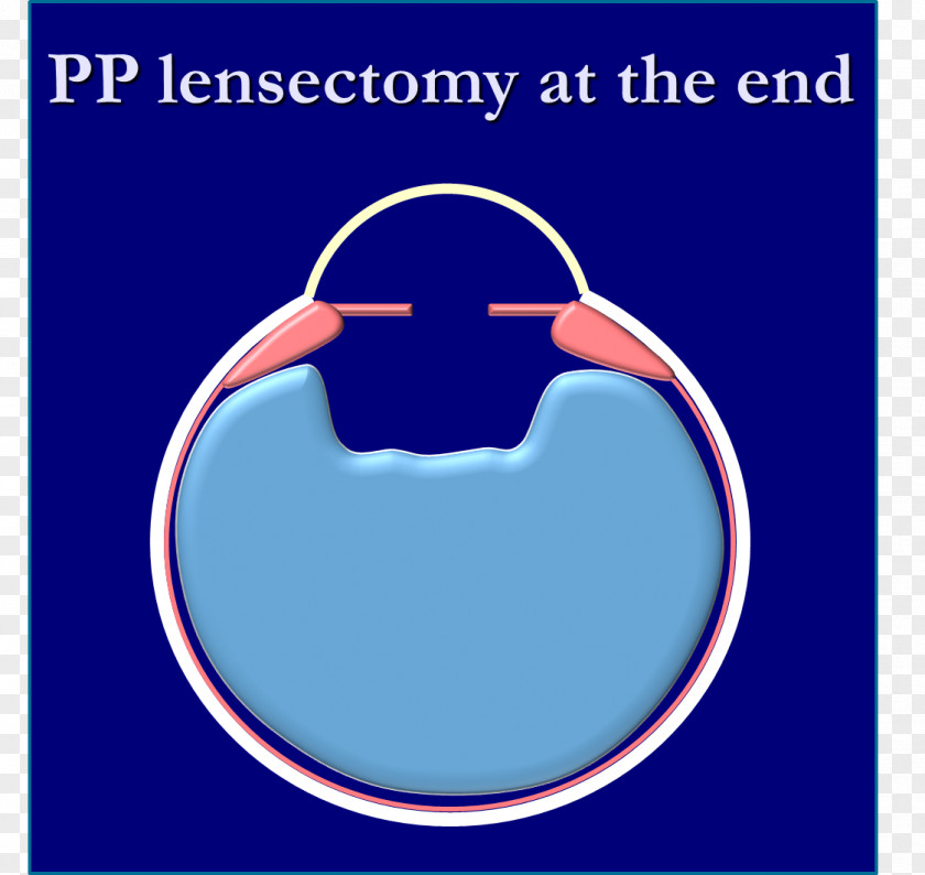 Aphakia Congenital Cataract Lens Diplopia PNG