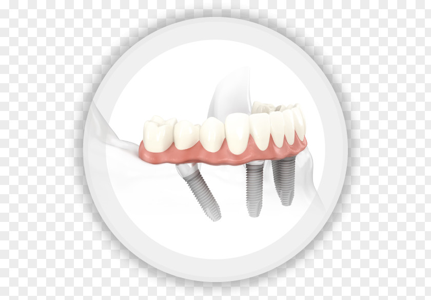 Bridge All-on-4 Dental Implant Dentistry Edentulism PNG